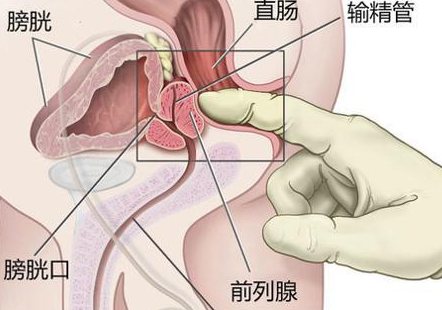 前列腺增生症科普小知识