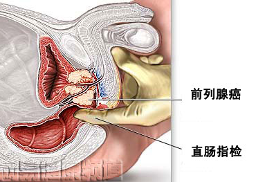 前列腺增生症科普小知识前列腺增生