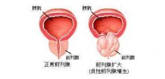 前列腺增生都会出现哪些症状？