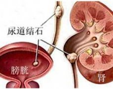 男性患有尿道结石很严重吗？